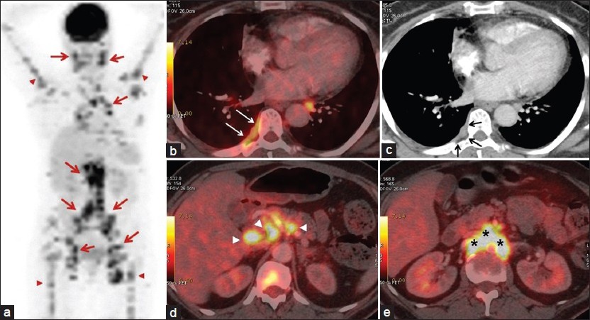 55-year-old woman presented with fatigue, swelling in the armpits, back pain, weight loss, and dry cough, later diagnosed with Stage 2 sacroidosis. (a) Positron emission tomography (PET) image shows involvement of lymph nodes (red arrows) and bones (red arrowheads). (b) Axial PET/CT and (c) contrast-enhanced CT images demonstrate right-sided hypermetabolic pleural thickening compatible with pleural sarcoidosis. Note that pleural involvement is indistinct on CT image (black arrows); however, the lesion is apparent on PET/CT (white arrows). Axial PET/CT image from (d) the level of porta hepatis shows discrete lymph nodes (arrowheads) and (e) the para-aortic region shows confluent lymph nodes (asterisk).