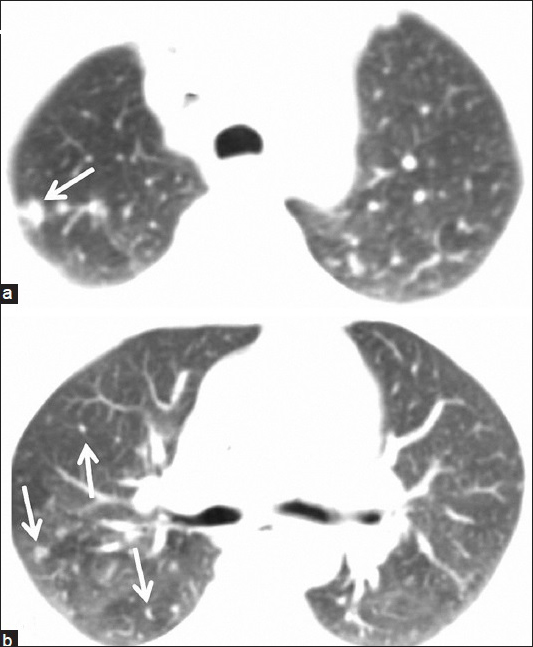 55-year-old woman presented with fatigue, swelling in the armpits, back pain, weight loss, and dry cough, later diagnosed with Stage 2 sacroidosis. (a and b) Axial thoracic CT images show right-sided lung nodules compatible with lung parenchyma involvement of sarcoidosis (arrows).