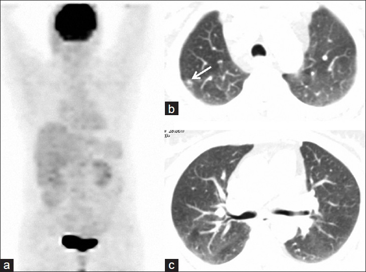 55-year-old woman presented with fatigue, swelling in the armpits, back pain, weight loss, and dry cough, later diagnosed with Stage 2 sacroidosis. (a) PET image obtained after corticosteroid treatment reveals total regression of hypermetabolic lesions. (b and c) Axial thoracic CT images from the same lung levels show regression in the parenchymal nodules. Note that right-sided nodules almost completely disappear and one prominent nodule of right apex significantly shrinks (arrow) after medical treatment.