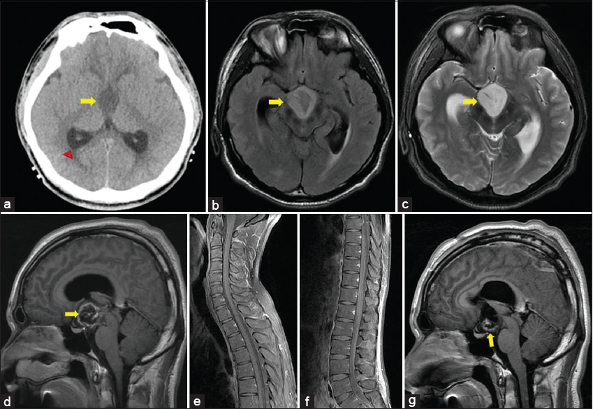 24-year-old male presented with a 3-month history of dull headache that had progressively worsened over 1 week with nausea and vomiting. (a) Axial noncontrast CT image shows a homogenously hypoattenuated mass in the third ventricle without hemorrhage or calcification (arrow). Secondary hydrocephalus is revealed (arrowhead). (b) Axial FLAIR image shows a mass of high signal intensity in the third ventricle (arrow). (c) T2-weighted image shows the mass to be hyperintense (arrow). (d) Contrast-enhanced T1-weighted image shows thick peripheral enhancement (arrow). (e, f) Contrast-enhanced T1-weighted images of spine show no cerebrospinal fluid dissemination. (g) Postoperative contrast-enhanced T1-weighted image shows remnant tumor in the floor of the third ventricle (arrow).