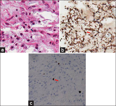 24-year-old male presented with a 3-month history of dull headache that had progressively worsened over 1 week with nausea and vomiting. (a) Photomicrograph (hematoxylin–eosin stain, original magnification ×400) shows overall monomorphic tumor cells (arrow) and prominent myxoid background without Rosenthal fibers or eosinophilic granular bodies. (b) Immunohistochemically, the tumor is strongly positive for glial fibrillary acidic protein, confirming its astrocytic origin (glial fibrillary acidic protein, original magnification ×400, arrow). (c) Proliferation of anti-Ki-67 monoclonal antibody (MIB-1)-positive tumor cells is low (MIB-1, original magnification ×400, arrow).