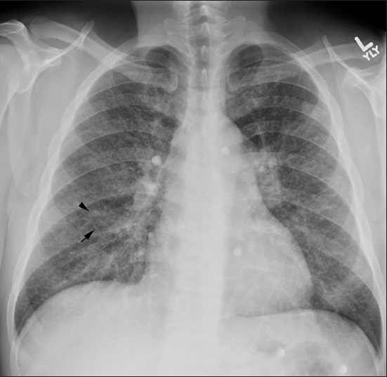 42-year-old previously healthy man presented to the hospital with 6 weeks of progressively worsening exertional dyspnea and non-productive cough diagnosed with pulmonary tumor thrombotic microangiopathy (PTTM) secondary to gastric adenocarcinoma. Chest X-ray posterioanterior (PA) view shows diffuse fine reticular (arrow) and nodular (arrowhead) opacifications.