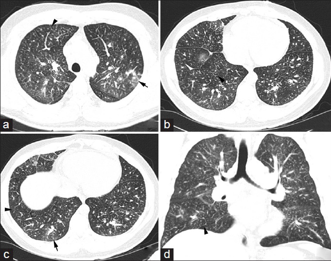 42-year-old previously healthy man presented to the hospital with 6 weeks of progressively worsening exertional dyspnea and non-productive cough diagnosed with pulmonary tumor thrombotic microangiopathy (PTTM) secondary to gastric adenocarcinoma. CT chest, lung window, (a-c) Axial slices show interlobular septal thickening (arrowheads) and centrilobular ground glass opacities (arrows), (d) Coronal view shows the same findings described above.