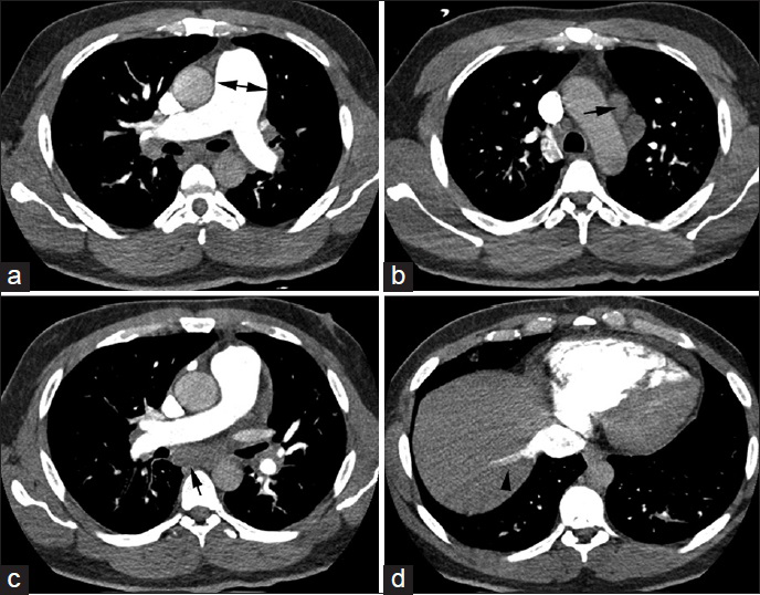 42-year-old previously healthy man presented to the hospital with 6 weeks of progressively worsening exertional dyspnea and non-productive cough diagnosed with pulmonary tumor thrombotic microangiopathy (PTTM) secondary to gastric adenocarcinoma. CT chest, soft tissue window, axial slices in all panels, (a) shows an enlarged pulmonary artery (double-headed arrow), (b and c) reveal mediastinal lymphadenopathy (arrows), (d) shows reflux of contrast into the inferior vena cava (arrowhead).