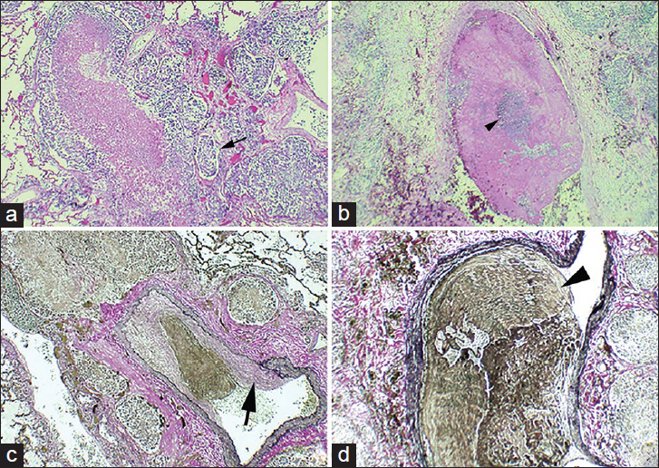 42-year-old previously healthy man presented to the hospital with 6 weeks of progressively worsening exertional dyspnea and non-productive cough diagnosed with pulmonary tumor thrombotic microangiopathy (PTTM) secondary to gastric adenocarcinoma. (a) Hematoxylin and eosin stained tissue (10×) shows medium sized blood vessels (small arrow) containing tumor emboli. (b), Hematoxylin and eosin stained tissue (20×) shows a singular blood vessel containing nests of tumor cells (small arrowhead) surrounded by fibrin debris. (c) Verhoeff's elastic stained tissue shows tumor thrombus with fibrocellular intimal proliferation (large arrow) within blood vessel (20×). (d) shows the same blood vessel shown in (b) stained with Verhoeff's elastic stain to highlight vessel wall (large arrowhead) (40×).