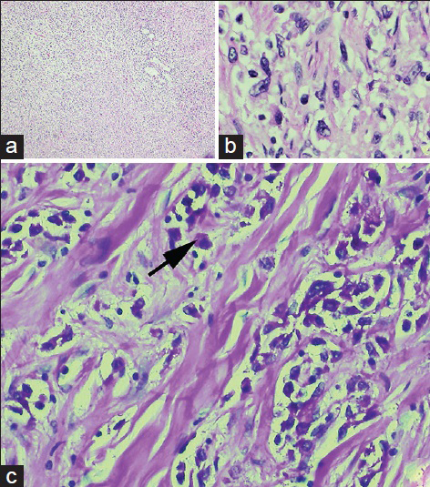 42-year-old previously healthy man presented to the hospital with 6 weeks of progressively worsening exertional dyspnea and non-productive cough diagnosed with pulmonary tumor thrombotic microangiopathy (PTTM) secondary to gastric adenocarcinoma. (a) Hematoxylin and eosin (H and E) stain stained tissue (20×) shows sheets of tumor cells seen at low power. (b) H and E stain (40×) reveals tumor cells of gastric origin. (c) Periodic acid-Schiff (PAS) stained gastric tissue with digestion at high power (40×) reveals intracytoplasmic mucin positivity (arrow).