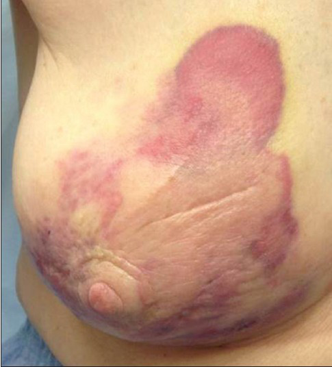 80-year-old woman with an erythematous lesion with irregular borders diagnosed with secondary angiosarcoma.