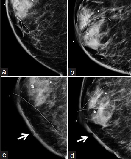 80-year-old woman with an erythematous lesion with irregular borders diagnosed with secondary angiosarcoma. (a) Craniocaudal (CC) and (b) mediolateral oblique (MLO) views of the right breast from a mammogram taken 2 years prior to diagnosis of angiosarcoma show smooth skin thickening and post-surgical change consistent with prior lumpectomy and radiation. (c) CC and (d) MLO views of the right breast at the time of diagnosis of angiosarcoma demonstrate interval increased skin thickening, as well as dimpling and irregularity of the skin (arrows).