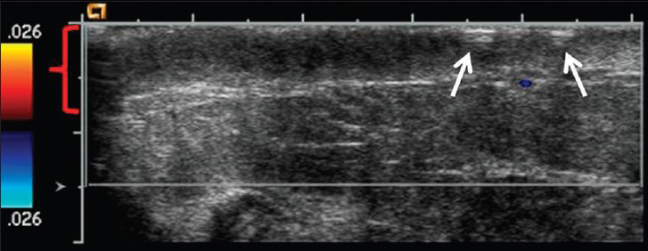 80-year-old woman with an erythematous lesion with irregular borders diagnosed with secondary angiosarcoma. Ultrasound image with color Doppler of the right breast reveals skin thickening of the inner central right breast (red bracket) as well as the dimpling and irregularity (arrows). No discrete mass or nodule was identified on ultrasound.