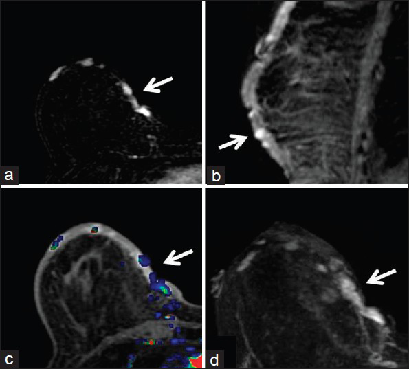 80-year-old woman with an erythematous lesion with irregular borders diagnosed with secondary angiosarcoma. (a) MRI subtraction axial image of the right breast demonstrates foci of enhancement medially (arrow). (b) Delayed contrast-enhanced T1-weighted sagittal image of the right breast shows the foci of enhancement (arrow) within the thickened skin of the inferior breast. (c) Early contrast-enhanced T1-weighted axial image with color-coded map of the right breast demonstrates the abnormal enhancement in the medial breast (arrow). (d) Early contrast-enhanced T1-weighted axial image of the right breast shows the foci of enhancement in the medial breast (arrow).