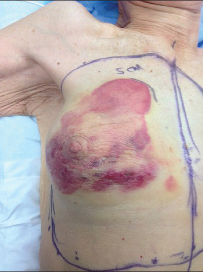 80-year-old woman with an erythematous lesion with irregular borders diagnosed with secondary angiosarcoma. Intraoperative photograph shows the extent of angiosarcoma and the outline of planned gross resection margins.