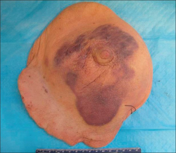 80-year-old woman with an erythematous lesion with irregular borders diagnosed with secondary angiosarcoma. Gross pathology image shows a 14.5 × 11.4 × 0.5 cm, irregular, blue/purple skin lesion surrounding the nipple.