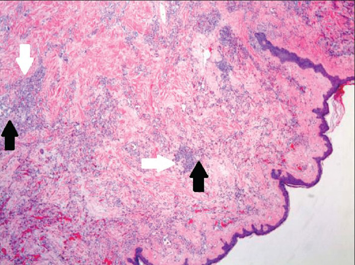 80-year-old woman with an erythematous lesion with irregular borders diagnosed with secondary angiosarcoma. Hematoxylin and eosin stained biopsy tissue at low magnification shows subcutaneous aggregates of solid spindle cell areas (white arrows) admixed with proliferation of irregular, variably sized interconnecting vascular channels (black arrows).