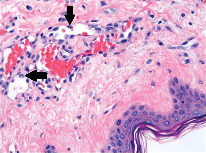 80-year-old woman with an erythematous lesion with irregular borders diagnosed with secondary angiosarcoma. Hematoxylin and eosin stained biopsy tissue at higher magnification shows irregular, variably sized interconnecting vascular channels lined by highly pleomorphic neoplastic cells (arrows), which have hyperchromatic nuclei and high nuclear to cytoplasmic ratio.