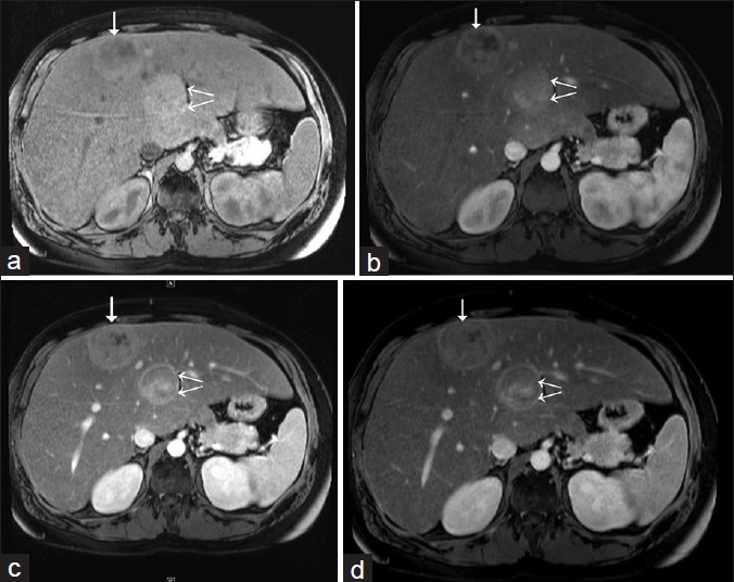 31-year-old man with known glycogen storage disease Type-1a undergoing surveillance imaging. Dynamic multiphase contrast-enhanced MRI obtained in May 2014. (a) Pre-contrast T1W axial image shows two hepatic lesions in segments 4 (double arrows) and 8 (single arrow). (b) T1W axial image (arterial phase) shows variable heterogeneity foci of both of the lesions and arterial enhancement. (c) T1W axial image (venous phase) shows persistent enhancement of hepatic lesions. (d) T1W axial image (delayed or equilibrium phase) shows subtle washout in both of the lesions; posterior lesion also shows peripheral rim enhancement (double arrows).