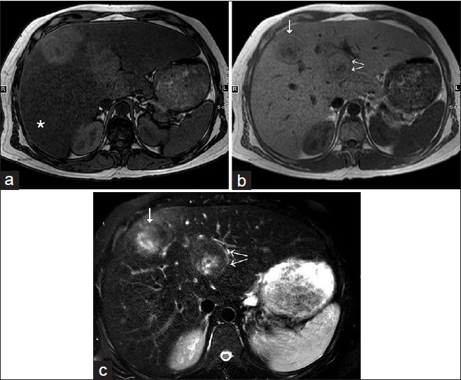 31-year-old man with known glycogen storage disease Type-1a undergoing surveillance imaging diagnosed with hepatic adenoma. (a) T1W opposed-phase axial image shows diffuse loss of intensity of hepatic parenchyma (asterisk), which suggests the presence of diffuse hepatic steatosis. Two hepatic lesions in segments 4 and 8 are relatively hyperintense on the background of steatosis and lack microscopic fat. (b) T1W in-phase axial image shows two hepatic lesions in segments 4 (double arrows) and 8 (single arrow). (c) Fat-suppressed T2W axial image demonstrates isointense to slightly increased intensity of the above-described hepatic lesions (see the corresponding arrows), with an eccentric, ill-defined, T2-hyperintense possible scar.