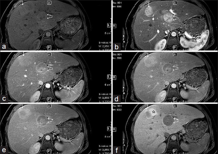 31-year-old man with known glycogen storage disease Type-1a undergoing surveillance imaging. Dynamic multiphase contrast-enhanced MRI obtained in Nov 2014 with gadolinium-EOB-DTPA. (a) Pre-contrast fat-suppressed T1W axial image shows two hepatic lesions in segments 4 (double arrows) and 8 (single arrow). The anterior lesion (single arrow) shows interval decrease in size, whereas the posterior lesion is slightly increased in size compared to MR dated May 2014 [Figure 2]. (b) Fat-suppressed T1W axial image (arterial phase) shows arterial enhancement of both hepatic lesions. (c) Fat-suppressed T1W axial image (venous phase) shows persistent enhancement of hepatic lesions; however, the anterior lesion (single arrow) appears fainter. (d) Fat-suppressed T1W axial image (delayed or equilibrium phase) shows remarkable washout in the posterior lesion (double arrows) with well-evident peripheral rim enhancement. (e and f) Fat-suppressed T1W axial image (hepatobiliary phases at 10 and 20 min, respectively) shows peripheral retention of the contrast in the anterior lesion (image f, star), which can be seen with inflammatory adenomas. The posterior lesion gradually becomes hypointense to the liver parenchyma and shows no uptake of contrast.