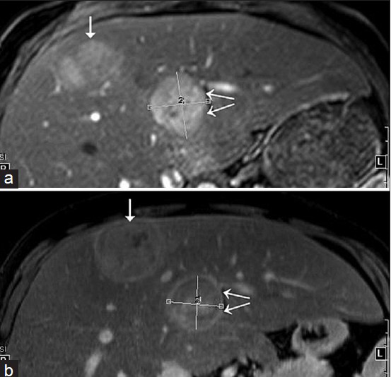 31-year-old man with known glycogen storage disease Type-1a undergoing surveillance imaging. Index images of two hepatic lesions with an interval of 6 months. (a) Fat-suppressed T1W fat post-contrast image acquired in Nov 2014. (b) Fat-suppressed T1W fat post-contrast image obtained in May 2014. The anterior lesion (single arrow) shows interval decrease in size on follow-up imaging, whereas the posterior lesion (double arrows) is slightly increased in size.