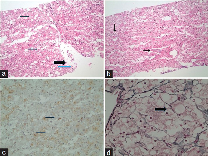 31-year-old man with known glycogen storage disease Type-1a. Post-biopsy histopathology of suspicious lesion seen on imaging. There is lack of portal tracts in all fragments. (a) In low-power magnification (hematoxylin and eosin stain), there is moderate steatosis (thin arrows) with many ballooned cells (thick arrow), some containing Mallory–Denk bodies (blue arrow). (b) In low-power magnification (hematoxylin and eosin stain), there are increased unpaired arteries (arrows). (c) In low-power magnification, there is focal Glypican-3 staining of the tumor cells. (d) In higher magnification, a reticulin stain shows focal loss of the reticulin framework (arrow).