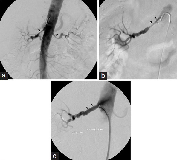 78-year-old woman with medically refractory hypertension and renal artery stenosis. (a) Abdominal aortogram exhibits stenosis of proximal renal arteries bilaterally (arrowheads). (b) Right renal arteriogram better delineates stenosis (arrowheads). (c) Final right renal arteriogram performed after primary stent deployment shows marked improvement in the renal artery caliber (arrowheads).