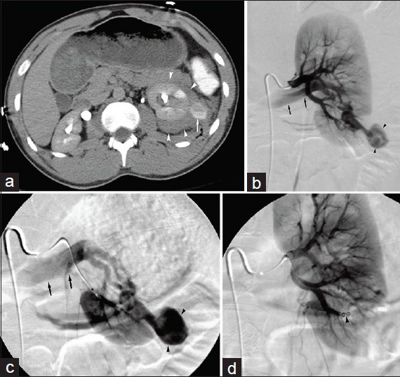 40-year-old man suffered penetrating flank trauma resulting in renal artery pseudoaneurysm. (a) Contrast-enhanced axial CT image reveals left peri-renal hematoma (arrowheads) and focal round high attenuation pseudoaneurysm (arrow). (b) Main left renal arteriogram and (c) selective left renal arteriogram demonstrate traumatic renal artery pseudoaneurysm (arrowheads). Note the presence of arteriovenous fistula, with early filling of renal vein (arrows). (d) Completion arteriogram following coil embolization (arrowhead) of feeding artery shows no filling of pseudoaneurysm.