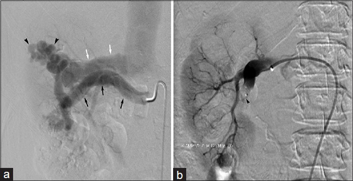 60-year-old woman with intermittent right flank pain found to have congenital renal arteriovenous malformation. (a) Right renal arteriogram demonstrates arteriovenous malformation (arrowheads). Note hypertrophy of main renal artery (black arrow) and early renal venous drainage (white arrow). (b) Final right renal arteriogram following vascular plug (arrowhead) embolization displays no residual filling of the renal arteriovenous malformation.