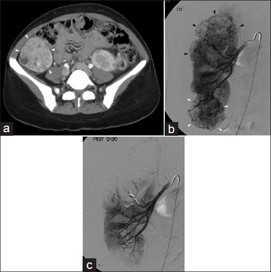 32-year-old asymptomatic woman with incidental discovery of renal angiomyolipoma. (a) Contrast-enhanced axial CT image in tuberous sclerosis patient demonstrates 5.8 cm right lower pole renal AML (arrow). (b) Right renal arteriogram displays multiple renal masses (arrowheads), consistent with the patient's known AMLs, including lower pole mass (white arrowheads). (c) Post-embolization right renal arteriogram shows no significant residual flow to embolized renal AMLs; in this case, particles and metallic coils were used.