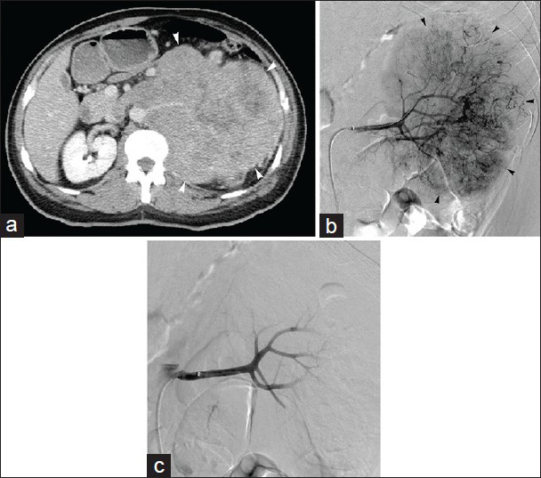 48-year-old man with flank pain found to have renal cell carcinoma. (a) Contrast-enhanced axial CT image demonstrates 19 cm left renal mass (arrowheads); preoperative embolization requested prior to resection. (b) Left renal arteriogram displays hypervascular tumor (arrowheads) with abundant neovascularity. (c) Post-embolization left renal arteriogram following particle embolization shows no significant residual flow to tumor, with pruning of distal vasculature; metallic coils placed in distal renal artery after particle devascularization (not shown).