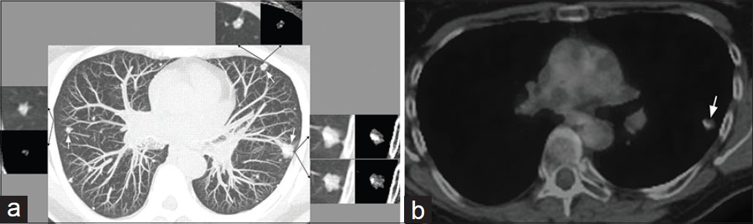 61-year-old woman with endothelial hemangioendothelioma presented for consideration of surgical resection, but was found to have pulmonary metastases which were previously thought to be calcified granulomas. (a) Non-contrast enhanced maximum intensity projection CT image shows several bilateral variable-sized peripheral-predominant nodules (white arrows pointing to the three largest nodules). Lung and mediastinal soft tissue window-levels of the three largest nodules are shown (black arrows point to the corresponding lung and mediastinal soft tissue window-levels). These larger nodules are associated with an irregularly marginated soft tissue component and eccentric calcifications. (b) PET/CT of the largest pulmonary nodule in the left upper lobe demonstrates minimal, if any, FDG uptake (arrow). This nodule in the left upper lobe was subsequently biopsied with the pathologic diagnosis of EHE.