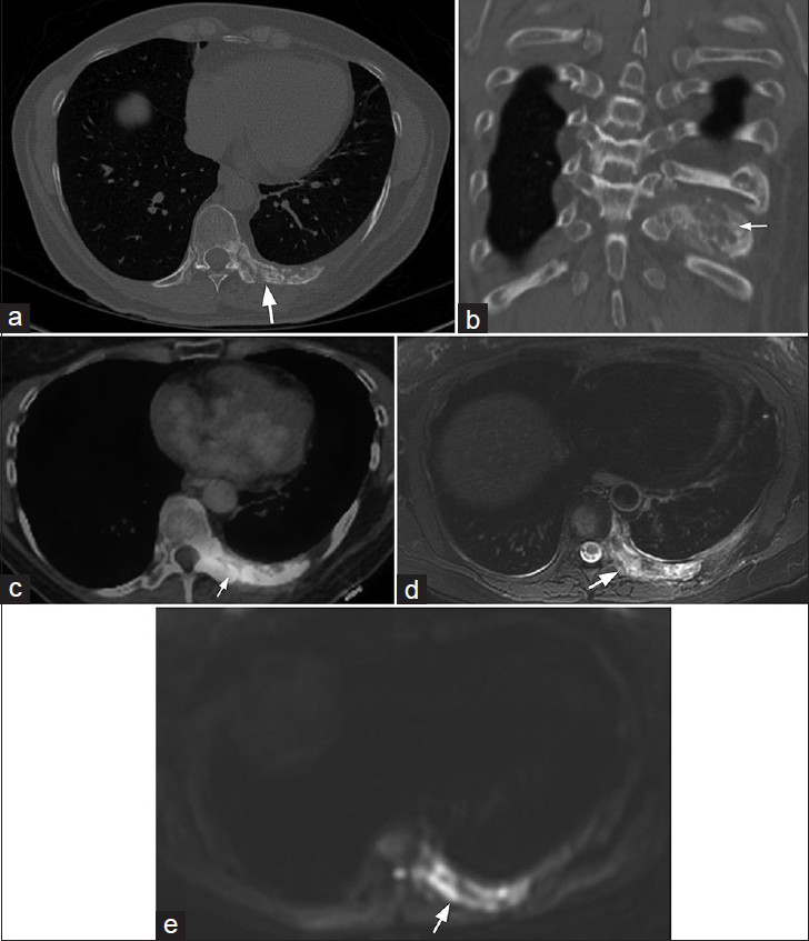 61-year-old woman with endothelial hemangioendothelioma presented for consideration of surgical resection, but was found to have pulmonary metastases which were previously thought to be calcified granulomas. (a) CT of the chest in the axial plane and (b) CT of the chest reformatted in the coronal plane with bony window-level settings of the left 9th rib show predominantly lytic lesions with osseous expansion of the posterior left rib(s), and associated sclerosis with extension to the articulating thoracic vertebral body and pedicle (arrows pointing to the rib lesion). (c) PET/CT demonstrates moderate FDG uptake (arrow). (d) Magnetic resonance T2-weighted image and (e) MR diffusion-weighted image of the lower chest included during magnetic resonance imaging of the abdomen show heterogeneous T2 signal hyperintensity and restricted diffusion associated with the rib involvement (arrows). This had been previously biopsied and shown to be EHE.