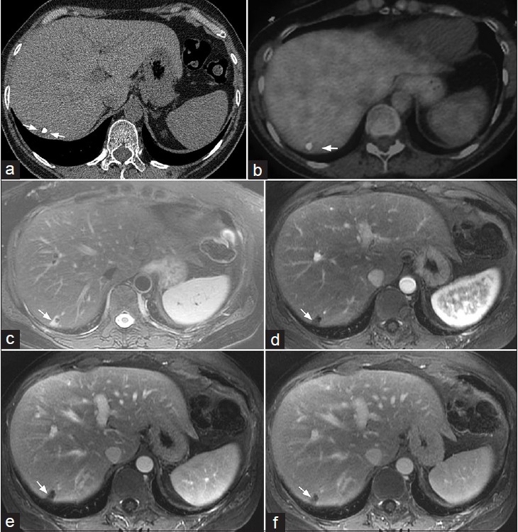 61-year-old woman with endothelial hemangioendothelioma presented for consideration of surgical resection, but was found to have pulmonary metastases which were previously thought to be calcified granulomas. (a) Axial non-contrast enhanced CT demonstrates a low attenuation mass with an associated coarse calcification (arrows delineating the mass). (b) PET/CT shows no appreciable FDG uptake in the peripheral right hepatic lobe. (c) MR T2-weighted image of the liver shows a wedge-shaped peripheral right hepatic lobe mass with increased T2 signal (arrow). (d–f) MR post-gadolinium axial 3D spoiled gradient recalled acquisition in steady state (SPGR) images of the liver acquired during the (d) arterial, (e) portal venous, and (f) delayed phases demonstrate minimal delayed peripheral enhancement of this mass (arrows). Imaging differential considerations include EHE and hemangioma. Biopsy of this mass was not performed.