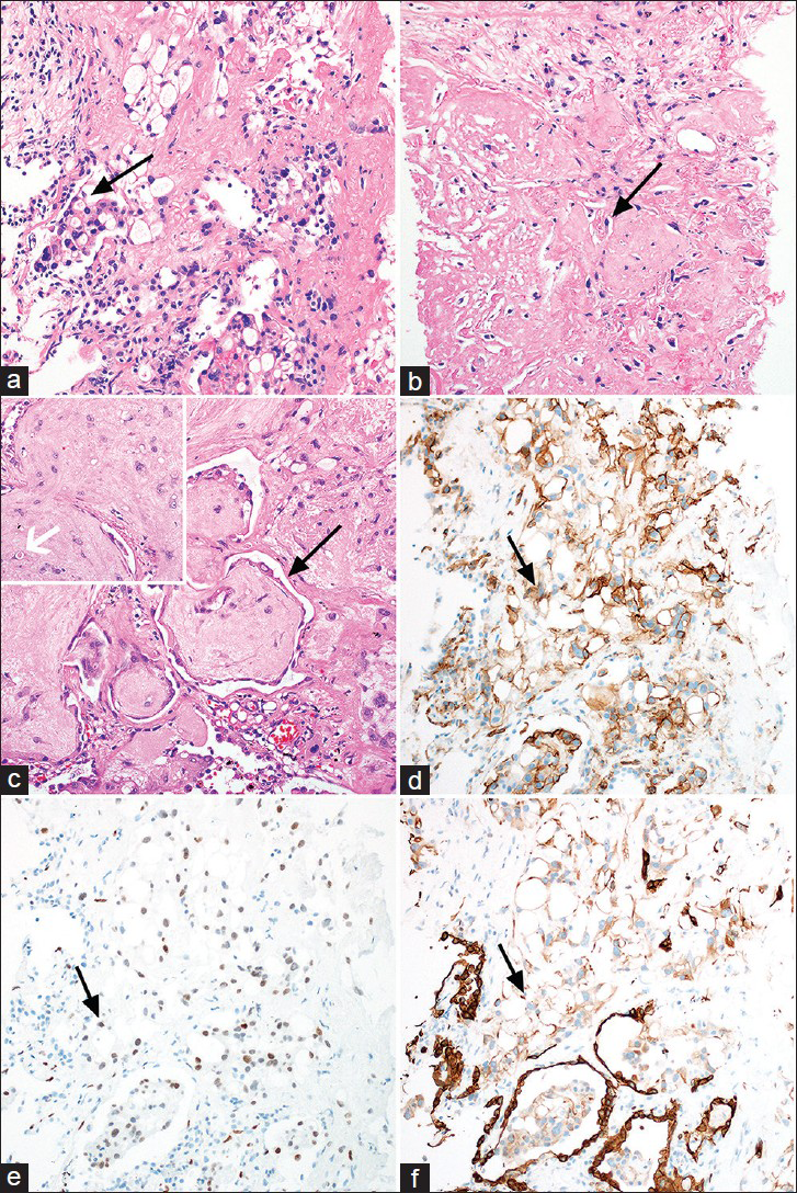 61-year-old woman with EHE presented for consideration of surgical resection, but was found to have pulmonary metastases which were previously thought to be calcified granulomas. (a–c) Photomicrographs of the lung mass biopsy, using hematoxylin and eosin (100× magnification) staining, reveal groups and cords of EHE cells with low-grade cytology and frequent intracytoplasmic vacuoles infiltrating the lung parenchyma (a, arrow pointing to an EHE cell with an intracytoplamsic vacuole), and embedded in a hyalinized matrix (b, arrow pointing to an EHE cell embedded within a hyalinized matrix). At the periphery of tumor nodules, EHE displays a micropolypoid growth pattern, in which the tumor protrudes into adjacent alveolar spaces (c, black arrow pointing to the tumor displaying a micropolypoid growth pattern). Occasionally, tumor cells have a fragmented erythrocyte within the intracytoplasmic vacuole (c, inset with white arrow pointing to an EHE cell containing a fragmented erythrocyte within an intracytoplasmic vacuole). tissue stained for (d) vascular markers CD31, (e) Fli-1 and (f) keratin AE1/AE3 show EHE cells are strongly positive for the vascular markers CD31 (black arrow pointing to a positive cell in d, 100× magnification) and Fli-1 (e, black arrow pointing to a positive cell, 100× magnification), and are often positive for keratin AE1/AE3 (black arrow pointing to a positive cell in f, 100× magnification), weak staining compared to the strongly staining alveolar epithelium, which is a common diagnostic pitfall.