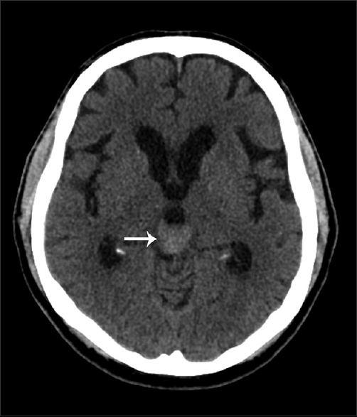 65-year-old male presented with headache and was later diagnosed with pineal gland lymphoma. Axial non-contrast CT of the head demonstrates a homogeneously hyperdense mass (arrow) in the pineal gland region. There are no calcifications or hemorrhage identified.