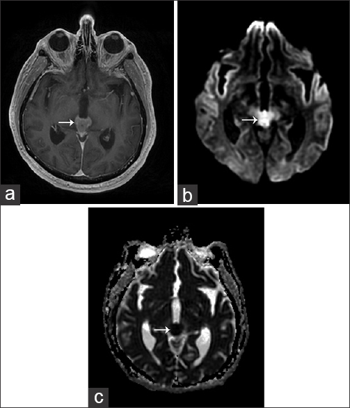 65-year-old male presented with headache and was later diagnosed with pineal gland lymphoma. (a) Axial T1 post-contrast MRI image of the head demonstrates a homogeneously enhancing mass (arrow) in the region of the pineal gland. (b) Axial MRI diffusion-weighted imaging (DWI) sequence demonstrates increased signal (arrow). (c) The corresponding axial apparent diffusion coefficient (ADC) map demonstrates low ADC values (arrow).