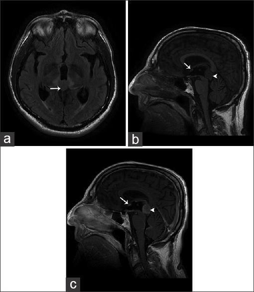 65-year-old male presented with headache and was later diagnosed with pineal gland lymphoma. (a) Axial T2 FLAIR MR image demonstrates the pineal gland mass (arrow) as isointense to mildly hyperintense to brain parenchyma. (b) Sagittal T1-weighted MR image demonstrates that the mass is hypointense. (c) Sagittal T1 post-contrast MR image again shows the enhancing pineal gland mass (arrowhead) as well as leptomeningeal enhancement near the supraoptic recess (arrow) and cerebellar velum.