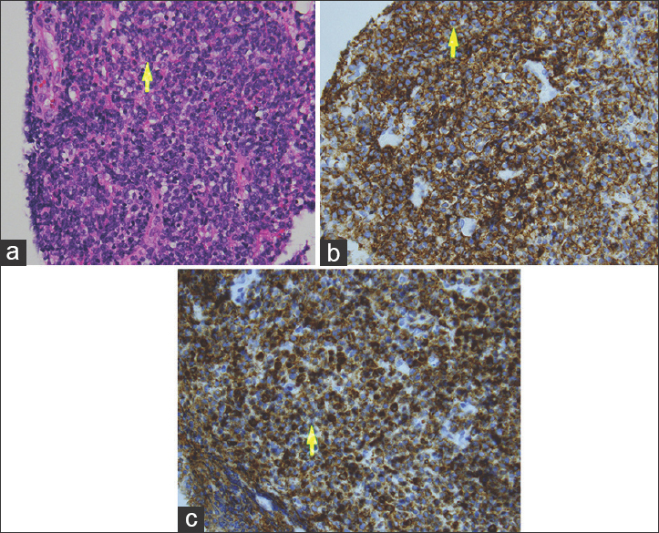 65-year-old male presented with headache and was later diagnosed with pineal gland lymphoma. (a) Hematoxylin and eosin staining at magnification (40×) demonstrates malignant lymphoma with coarse chromatin, nucleoli (arrow), and mitoses. (b) Diaminobenzidene chromagen at magnification (40×) demonstrates tumor cells (arrow) extensively exhibiting CD20 reactivity. (c) Diaminobenzidene chromagen at magnification (40×) demonstrates tumor cells (arrow) exhibiting extensive CD79a, but no neural, myogenic, or epithelial marker immunoreactivity.