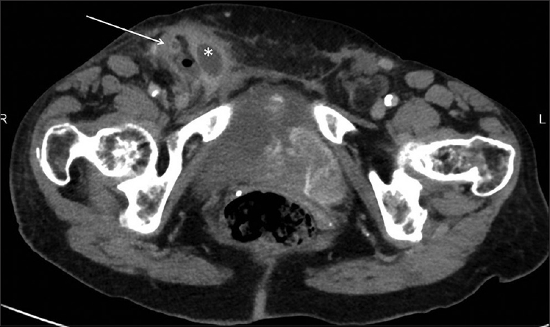 86-year-old female with fever and tender swelling in the groin caused by a periappendicular abscess and diagnosed with appendicitis within an inguinal hernia. Axial computed tomography (CT) image of the pelvis shows multilocular fluid collection (*) and gas bubble within a right inguinal hernia. The 8-mm thick appendix (arrow) is seen laterally.