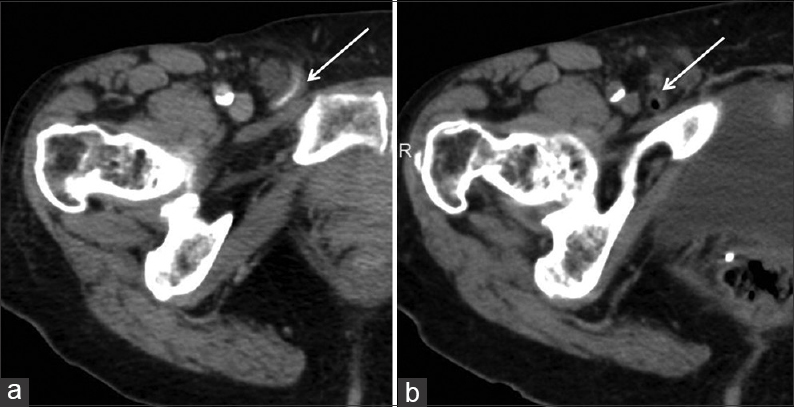 86-year-old female with fever and tender swelling in the groin caused by a periappendicular abscess and diagnosed with appendicitis within an inguinal hernia. Axial CT images of the pelvis taken in 2008 and 2010 are presented. (a) The 2008 study shows a contrast-filled appendix in its long axis (arrow). (b) The 2010 scan shows the gas-filled appendix in its short axis (arrow).