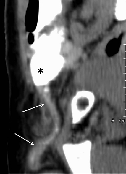 86-year-old female with fever and tender swelling in the groin caused by a periappendicular abscess and diagnosed with appendicitis within an inguinal hernia Curved-plane reconstruction of the right groin from the 2008 CT study in Figure 2a shows the appendix (arrows) originating from the base of the contrast-filled cecum (*), extending caudally into the hernia sac.