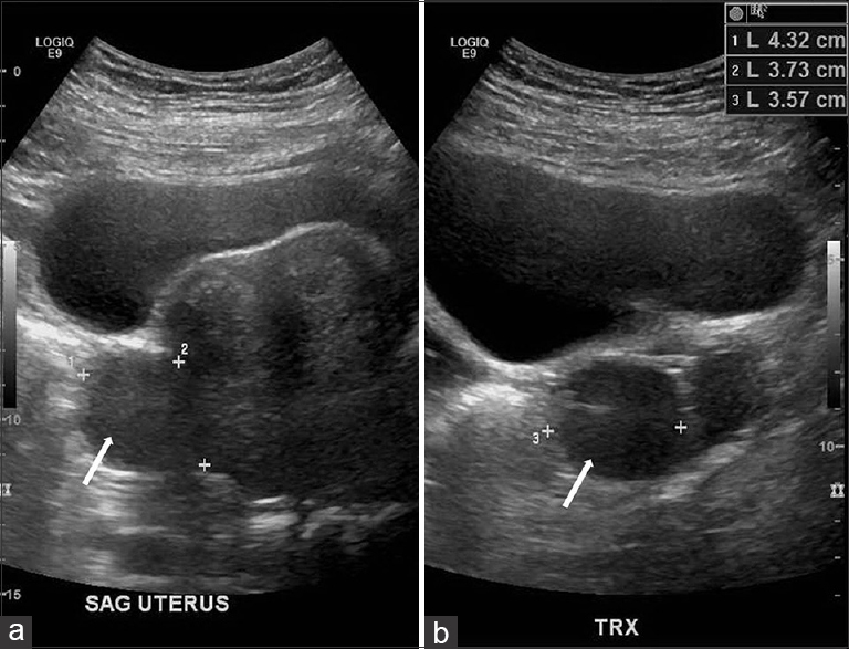 42-year-old female with a history of chronic iron deficiency anemia and menorrhagia for several years and later diagnosed with cystic lymphangioma of the small bowel mesentery. Transabdominal ultrasound (a) sagittal and (b) transverse scans demonstrate a bulky uterus with a subserosal fibroid (white arrows) seen in both sagittal and transverse planes.