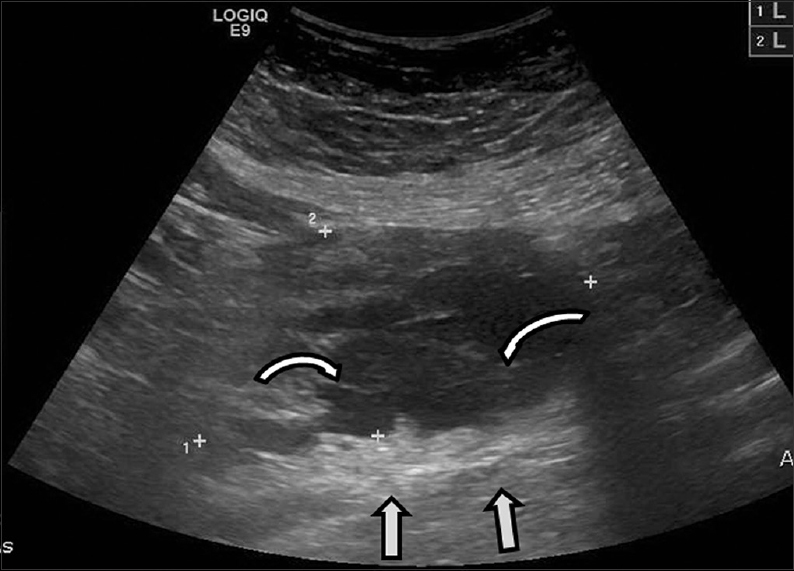 42-year-old female with a history of chronic iron deficiency anemia and menorrhagia for several years and later diagnosed with cystic lymphangioma of the small bowel mesentery underwent pelvic ultrasound for investigation of menorrhagia and was found to have a complex cystic right adnexal mass. Transabdominal ultrasound demonstrates a cystic lesion with numerous thin septae (curved arrows) and good through transmission (straight arrows).