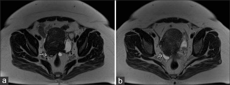 42-year-old female with a history of chronic iron deficiency anemia and menorrhagia for several years and later diagnosed with cystic lymphangioma of the small bowel mesentery. Axial T2 images (a and b) demonstrate tethering of right ovary (arrows) to the uterus posteriorly.