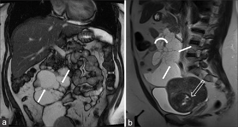 42-year-old female with a history of chronic iron deficiency anemia and menorrhagia for several years and later diagnosed with cystic lymphangioma of the small bowel mesentery. (a) Coronal fast imaging with steady-state precession (FISP) demonstrates a multiloculated cystic lesion with numerous septae (straight arrows), lacking mass effect. (b) Sagittal T2 (13 months later) of lesion, shows increase in size of lesion with thin-walled septae (straight arrows) and insinuating around the mesenteric vessels (curved arrow). Note the uterine fibroid with evidence of cystic degeneration (hollow arrow).