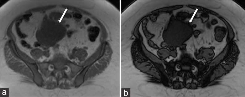 42-year-old female with a history of chronic iron deficiency anemia and menorrhagia for several years and later diagnosed with cystic lymphangioma of the small bowel mesentery. Corresponding axial T1 (a) in-phase and (b) out-of-phase MR images demonstrate the cystic lymphangioma (straight arrows) with signal intensity loss on the out-of-phase image (b) compared to the in-phase image, indicative of microscopic lipid content of chylous fluid.