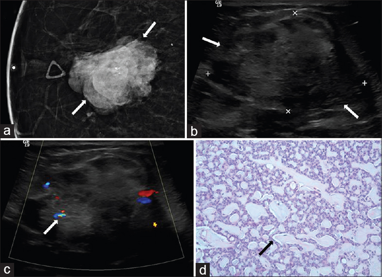 55-year-old female with adenoid cystic carcinoma. The patient initially presented for evaluation of a palpable abnormality in the right breast. (a) Spot compression craniocaudal (CC) view of the right breast demonstrates a dense irregular mass with a few coarse appearing calcifications (arrows), corresponding to the palpable finding. (b) Gray-scale and (c) color Doppler images demonstrate a heterogeneous mass with indistinct margins (arrows) and internal vascularity (arrow) measuring up to 5 cm. The mass contains a few anechoic cystic regions and no posterior acoustic features. (d) Photomicrograph [hematoxylin and eosin stain (H and E), 20×] shows typical cribriform pattern and epithelial cells lining periodic acid Schiff (PAS) positive material (arrow).