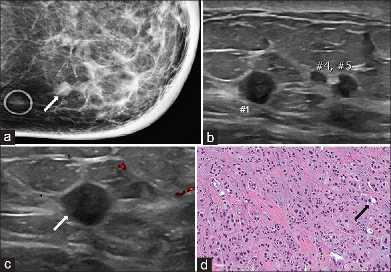 72-year-old female with apocrine carcinoma. The cancer was initially found in the left axillary region. The patient subsequently developed local recurrence in both the left axilla and the left breast. (a) Spot compression CC view of the left breast demonstrates multiple partially obscured masses in the inner breast (arrow). Note is made of diffuse skin and trabecular thickening. (b) Gray-scale and (c) color Doppler images of the left breast demonstrate multiple circumscribed hypoechoic masses correlating with the findings seen on mammography (numbers and arrow). (d) Photomicrograph of the surgical specimen (H and E stain, 20×) demonstrates the typical pattern of granular eosinophilic cytoplasm, round vesicular nuclei, and scattered regions of cytoplasmic vacuolization (arrow).