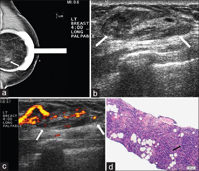 Extranodal marginal zone lymphoma. (a) Spot magnification mediolateral (ML) view of the left breast demonstrates a focal asymmetry in the lower breast, posterior depth (arrow). This corresponds to a palpable finding. (b) Gray-scale and (c) color Doppler images demonstrate a superficial oval vascular mass in the 4:00 position (arrows) corresponding to the mammographic and palpable findings. (d) Photomicrograph of the surgical specimen (H and E stain, 10×) shows small lymphocytes with dense nuclear chromatin infiltrating extensively into fibroadipose tissue and forming a vaguely nodular pattern (arrow).