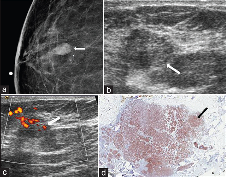 Neuroendocrine carcinoma. (a) Spot compression CC view of the right breast shows an oval mass (arrow) with associated amorphous calcifications in the lower breast, anterior depth. (b) Gray-scale and (c) color Doppler ultrasound images demonstrate a vascular hypoechoic mass with indistinct margins (arrows) corresponding to the mammographic abnormality. (d) Immunohistochemical stain for neuroendocrine marker synaptophysin (1×) shows diffuse staining of the tumor cells (arrow).