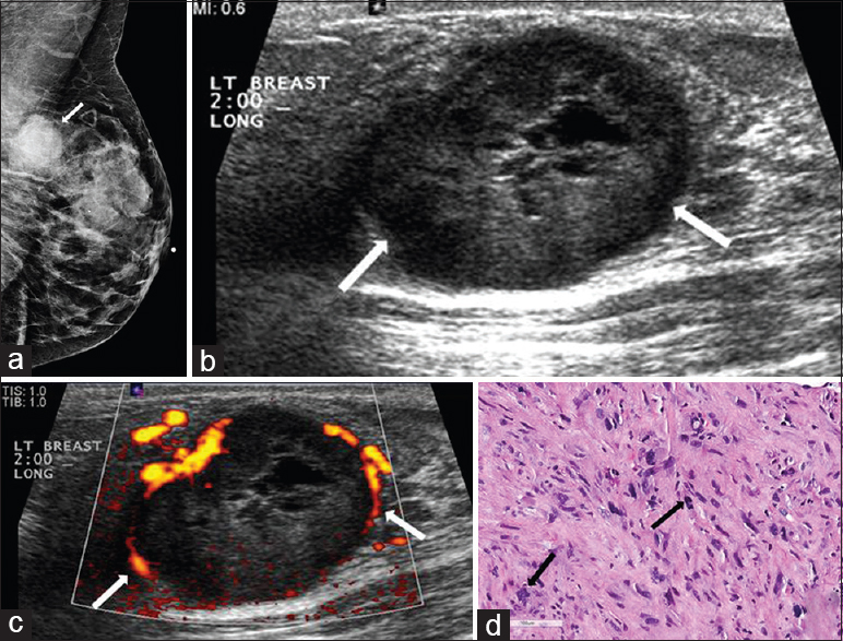 Metaplastic breast carcinoma. (a) Mediolateral oblique (MLO) view of the left breast demonstrates a partially circumscribed mass in the upper position of the posterior breast (arrow). (b) Gray-scale and (c) color Doppler images of the left breast demonstrate an ovoid, predominantly hypoechoic circumscribed mass with cystic components and vessels in rim in the 2:00 position (arrows). (d) Photomicrograph of the surgical specimen (H and E stain, 20×) shows a spindle cell proliferation with multinucleated giant cells and atypical mitosis (arrows).