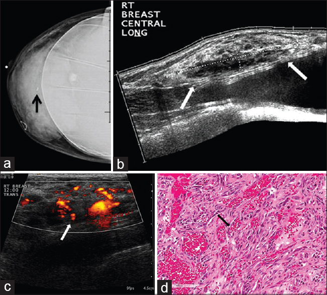 42-year-old female with angiosarcoma of the breast. The patient presented with a right breast mass. (a) CC implant view of the right breast demonstrates a mass in the central right breast with a biopsy clip in place (arrow). (b) Gray-scale and (c) color Doppler images of the right breast show a large heterogeneous mass with internal vascularity (arrows) corresponding to mammographic abnormality. (d) Photomicrograph of the surgical specimen (H and E stain, 20×) shows a portion of the tumor composed of solid and spindle cell foci with multiple blood “lakes” (arrow), indicating the vascular nature of tumor.